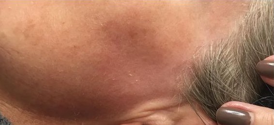 Release Peeling